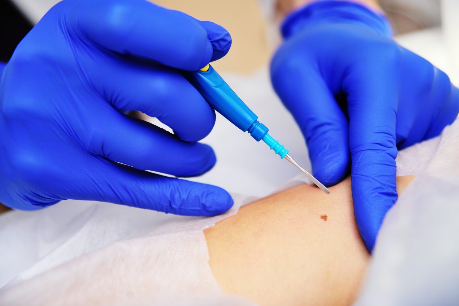 Choosing The Right Electrosurgical Device For Your Clinic